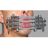 Baillon Block Lips Métal